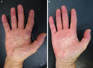 A) Lesiones papulosas eritematovioláceas induradas en palmas y cara volar de dedos. B) Postratamiento: se aprecia resolución completa de las lesiones.