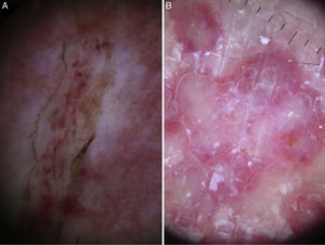 Dermoscopic findings in Pelagia noctiluca stings. Serpentine ulceration and circular milky-red areas. (A) Superficial linear ulceration presents as a winding road due to the contact with the tentacles of the jellyfish (“serpentine ulceration”). The edges of the ulcer are delimited by scales and contain brown dots. Linear purpura is shown inside the ulcer. (B) Distinctive “circular milky-red areas” on a recurrent, persistent, inflammatory reaction to jellyfish sting. The configuration of these circular milky-red areas match with the “warts” morphology of the jellyfish.