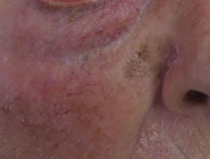 Lesión pigmentada plana en la cara de una persona mayor.