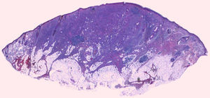 Histopatología: panorámica de neoplasia dérmica que infiltra el tejido adiposo subcutáneo (hematoxilina-eosina, ×10).