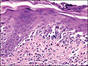Histopatología: intensa lesión vacuolar de interfase, aislados queratinocitos necróticos y extenso despegamiento dermo-epidérmico, sin necrosis epitelial (Hematoxilina-eosina. 10x).