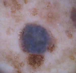 Dermatoscopia que muestra la colisión de un nevus azul con un patrón azul homogéneo, y varios nevus melanocíticos con un patrón globular típico.