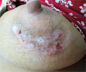 Papular-pustular plaque on the left breast with central scarring and a purulent discharge visible at the periphery.