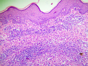 Acanthosis of the epidermis with a mixed cell inflammatory infiltrate in the superficial and mid dermis. Hematoxylin and eosin, original magnification ×100.