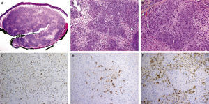 a) Nódulo circunscrito, no encapsulado, en dermis superficial, sin contacto con la epidermis (H&E ×2); b) Patrón arquitectural plexiforme. Las células neoplásicas se disponen formando nidos redondeados e irregulares sobre un estroma predominantemente mixoide. Dichos nidos están desprovistos de estructuras neurales o vasculares en su porción central (H&E ×10); c) La mayoría de las células neoplásicas tienen núcleos ovoides con nucléolos inconspicuos y citoplasma eosinofílico con bordes mal definidos. Estas células están íntimamente entremezcladas con otras fusiformes de núcleos delicados, elongados e hipercromáticos; d) MiTF positivo de forma difusa en los núcleos de las células neoplásicas (×10); e) Claudina-1 positivo focalmente en las células neoplásicas (×10); f) CD163 positivo en numerosas células intersticiales entre los «plexos» (×10).