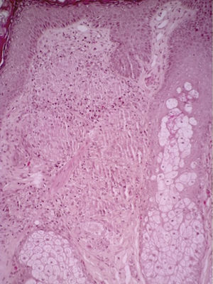 Infiltrado inflamatorio granulomatoso constituido por histiocitos y alguna célula gigante tipo Langhans (H-E ×10).