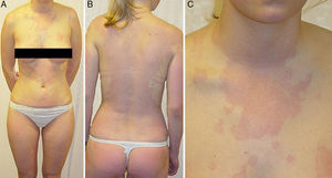 A y B. Rash eritematoso generalizado con afectación principal de la cara (no se muestra en la imagen) y en el tronco de la paciente11. C. Primer plano de la zona alta del tórax. Nótese la ausencia de habones. Reproducida con permiso de Jantschitsch et al.11.