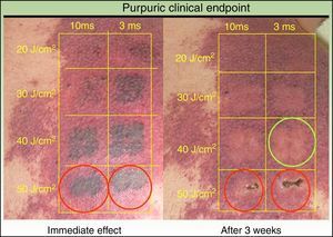Clinical endpoints. Correct therapeutic clinical endpoint: transient gray color that gradually evolves into persistent deep purpura (green circle). Overtreatment: persistent gunmetal gray or white color (red circle).