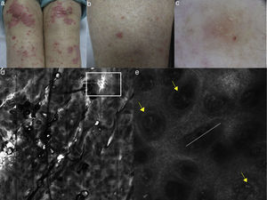 (a, b) Clinical pictures of plaque psoriasis involving lower limbs; (c) typical dermoscopic pattern of psoriasis characterized by red dots and glomerular vessels; (d) RCM Vivablock mosaic taken at the level of the dermo-epidermal junction showing hyperkeratosis (white square) and prominent papillomatosis, diffusely distributed; (e) RCM detail of non-rimmed, enlarged (white line) dermal papillae, increased in number and density separated by thin epithelial septa, and full filled by dilated blood vessels (yellow arrows).