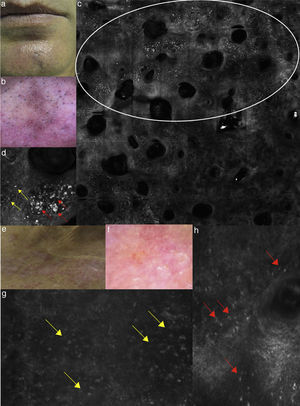 (a) Clinical picture of lichen planus; (b) dermoscopy reveals the presence of diffused blue-grey pigmentation arranged in a network around adnexal structures typical of a late stage lichen planus; (c) RCM Vivablock mosaic showing interface changes (white circle) with the presence of diffused inflammatory cells infiltrate, focused around adnexal structure, composed by numerous brightly reflactile, plump, oval to polygonal cells corresponding to melanophages (red arrows) and lymphocytes (yellow arrows); (e) clinical image of DLE; (f) dermoscopy shows teleangectasias associated with erythema; (g) RCM single frame at the level of the DEJ showing the obscuration of the DEJ by inflammatory cells (yellow arrows); (h) RCM detail of inflammatory process located around the adnexal structure with loss of the normal honeycombed structures of the epidermis; the inflammatory infiltrate is composed mainly by small, refractile, roundish cells corresponding probably to lymphocytes (red arrows).