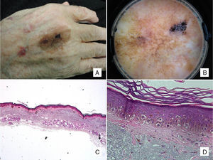 Caso 2: paciente de 88 años de edad, con mácula pigmentada en la mano de años de evolución. A. Mácula pigmentada, asimétrica tanto en morfología como en pigmentación. B. En la dermatoscopia se aprecia pigmentación anular granular en uno de los márgenes, con estructuras romboidales y áreas de regresión. C. Extirpación de una lesión tumoral constituida por una proliferación individual de melanocitos con halo claro sobre una piel con daño actínico (intensa elastosis solar) y atrofia epidérmica (H-E ×20). D. A mayor aumento observamos esta proliferación de células epitelioides que ascienden a capas altas, y fibrosis subepidérmica (H-E ×200).