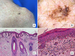Caso 4: varón de 63 años con lesión pigmentada en la escápula. A. Mácula pigmentada de 13mm en la escápula izquierda. B. La dermatoscopia revela la presencia de pigmentación perifolicular asimétrica, estructuras romboidales y algún folículo obliterado. Además podemos encontrar hallazgos típicos del melanoma de extensión superficial, como retículo atípico, áreas de regresión y la presencia de un velo azul blanquecino. C. Proliferación individual y en pequeños nidos de melanocitos epitelioides en la epidermis, con infiltrado inflamatorio acompañante, afectación del epitelio anexial y elastosis solar (H-E ×100). D. A mayor aumento se observa la presencia de melanófagos en la dermis papilar (H-E ×200).