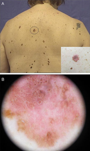 Clínica y dermatoscopia. A) Lesión pigmentada de aproximadamente 1cm, bordes irregulares y heterocroma. B) Patrón globular atípico, con retículo negativo, color rojo, blanco y azul.