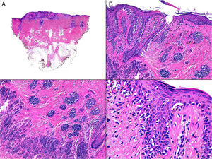 Histología. A) Lesión de patrón trizonal (H&E: visión panorámica). B y C) Proliferación melanocítica atípica en la unión dermoepidérmica con un área cicatrizal, con tecas melanocíticas también atípicas y un nevo residual, de patrón congénito, tanto en la periferia como por debajo de la cicatriz (H&E ×100). D) Ocasional extensión pagetoide en la epidermis de las células melanocíticas, en otras zonas (H&E ×400).
