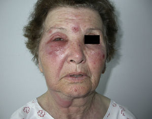 Edematous plaque on the right periocular area.