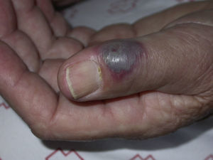 Violaceous plaque on finger.