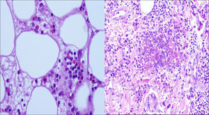 Infiltrate of eosinophils in the fat and flame figure in the dermis.