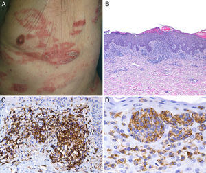 A) Placas eritematodescamativas, infiltradas, de morfología arciforme, localizadas en tronco. B) Denso infiltrado compuesto por linfocitos atípicos con epidermotropismo (H&E ×20). C) Positividad para CD4. D) Positividad para CD30 en el infiltrado epidermotrópico.