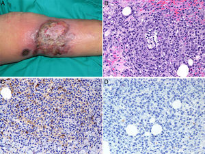A) Placa de gran tamaño ulcero-necrótica en cara interna de la pierna. B) Infiltrado angiotrópico de linfocitos atípicos (H&E ×100). C) Pérdida de expresión de CD4. D) Pérdida de expresión de CD30.