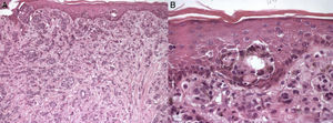 Histopatología, tinción con hematoxilina y eosina. A) Aumento ×10, se observan estructuras glandulares de adenocarcinoma mamario. B) Aumento ×40, se observa la presencia de pigmento en células tumorales superficiales y en dermis superficial.