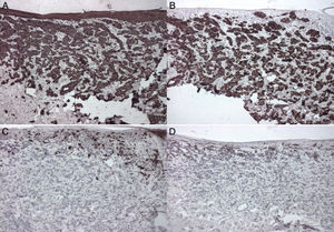 Inmunohistoquímica. A) CK positivo. B) CK7 positivo. C) S100 negativo. D) HMB45 negativo.