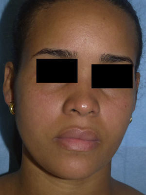 Eritema y edema malar bilateral asociados a inyección conjuntival.