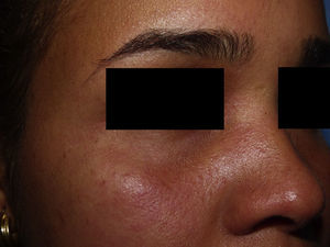 Detalle de la llamativa inyección conjuntival.