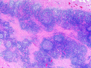 Folículos linfoides en el tejido celular subcutáneo, separados por zonas de fibrosis en el pseudolinfoma por vacunación (hematoxilina-eosina ×10).