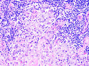 Histiocitos con citoplasma granular basófilo, correspondiente al aluminio de la vacuna, entremezclados con linfocitos, así como con eosinófilos y células plasmáticas (hematoxilina-eosina ×40).