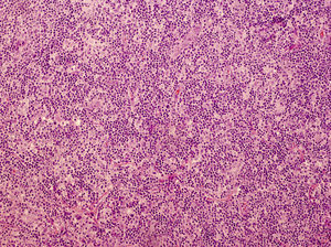 Imagen histológica del linfocitoma cutis mostrado en la imagen anterior. Infiltrado mixto dérmico denso. Pueden observarse centros germinales confluyentes desprovistos de la zona del manto, simulando la imagen de un linfoma de células B (hematoxilina-eosina ×20).