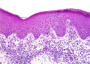 Dermatitis de contacto linfomatoide. En esta paciente sensibilizada a metilcloroisotiazolinona y a colofonia la histología mostraba un infilitrado linfocitario en banda, y en algunas zonas sin espongiosis la presencia de agrupaciones en la epidermis que recordaban a los microabscesos de Pautrier.