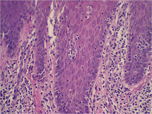 Detalle de los pseudomicroabscesos de Pautrier. Las lesiones se resolvieron tras la evitación de los alérgenos responsables.