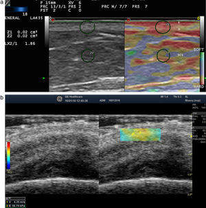 a) Elastografía de strain de la piel normal. Obsérvese el ratio de rigidez de dermis y la grasa SR=1,86 que indica que la dermis es más dura que el tejido celular subcutáneo. E: epidermis; D: dermis; TCS: tejidocelular subcutáneo. b) Elastografía SW de la dermis del cuero cabelludo. Obsérvese en la esquina inferior derecha los parámetros de velocidad y presión de la región de interés analizado (rectángulo verde-amarillento).