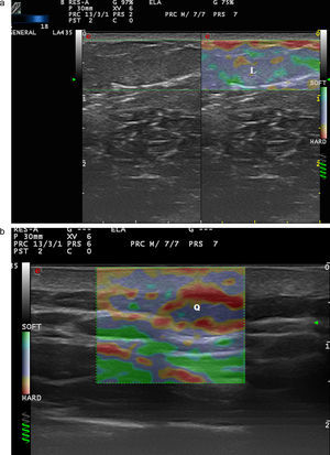 a) Elastografía de strain en un lipoma (L). b) Elastografía de un quiste (Q).