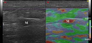 Elastografía de strain en una metástasis ganglionar de melanoma (M). Nótese rigidez completa de la lesión sin zonas blandas.