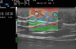 Elastografía en morfea (M). Se aprecia aumento de dureza de la interfase dermosubdérmica en la placa respecto al tejido circundante (SR=3,4).
