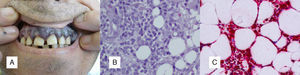 A. Encías edematosas, de coloración violácea, con sangrado occasional. B. Infiltración tumoral del tejido celular subcutáneo (H-E ×100). C. La muestra mostraba positividad para lisozima.