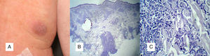 A. Niño de 2 años de vida, con nódulos eritemato-marronáceos en el tronco y la cara de 2 semanas de evolución. B. Infiltración tumoral del tejido celular subcutáneo (H-E ×100). C. Tinción inmunohistoquímica positiva para lisozima.