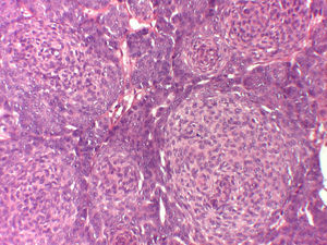 Hematoxilina-eosina (×20). Estructuras redondeadas claras compactas, a modo de capas de cebolla, «bolas celulares», o nidos de células de citoplasma pálido y núcleo vesiculoso, característicos del tricogerminoma.