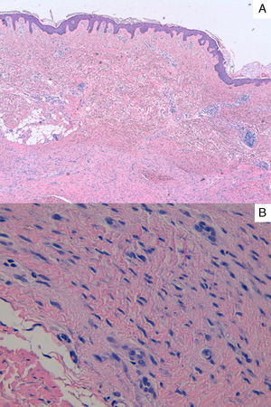A. Proliferación dérmica de células fusiformes en haces entrecruzados, con tendencia a disponerse en paralelo a la superficie cutánea (hematoxilina-eosina ×40). B. Detalle de la celularidad con núcleos elongados y ondulados de borde romo (hematoxilina-eosina ×400).