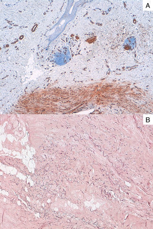 A. Tinción inmunohistoquímica difusa de las células tumorales para actina de músculo liso (AML) (AML ×40). B. Tinción histoquímica con orceína que muestra fibras reticuladas aumentadas y fragmentadas (orceína ×100).