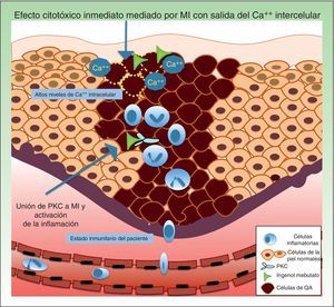 Los mecanismos de resistencia que se pueden ver involucrados en la terapia con mebutato de ingenol son los niveles de Ca++ intracelular, a nivel de los receptores de unión y del propio estado inmunitario del paciente. Ca++: calcio; MI: mebutato de ingenol; PKC: proteína quinasa C; QA: queratosis actínica.