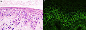 Imágenes histológicas: A) Detalle de espongiosis neutrofílica (hematoxilina-eosina ×40). B) Depósitos intercelulares de IgG (inmunofluorescencia directa).