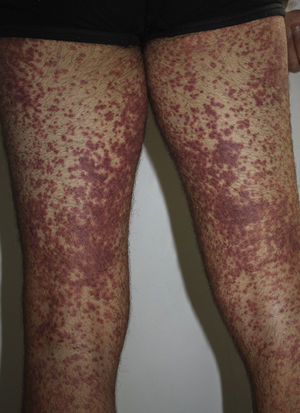 Lesiones maculopapulosas eritematosas de tinte purpúrico en miembros inferiores.