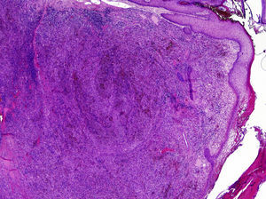 Proliferation of fine, irregular vascular channels, with erythrocyte extravasation (hematoxylin–eosin staining, original magnification ×20).