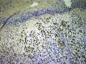 Nuclear positivity for human herpes virus 8 (hematoxylin–eosin staining, original magnification ×20).