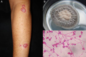 Esporotricosis linfangítica (A), cultivo de Sporothrix schenckii (B) y microscopia del cultivo ([C] medio Sabouraud dextrosa agar. Tinción eritrosina 2%, ×40).
