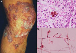 Cromoblastomicosis nódulo-verrugosa (A). Biopsia con células fumagoides (B). Examen directo de cultivo de Fonsecaea pedrosoi (C) (biopsia, tinción H-E y tinción de eritrocina al 2%; Ambas ×40).