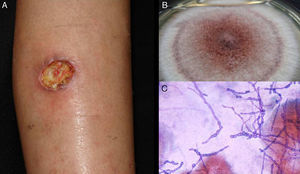 Úlcera de hialohifomicosis por Acremonium sp. (A). Cultivo (Sabouraud dextrosa agar) (B); y examen directo del exudado (Giemsa, ×40) (C).