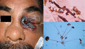 Mucormicosis rinocerebral-cutánea en paciente diabético descompensado. Hifas cenocíticas en la biopsia (Grocott, 40×) y examen directo de Rhizopus arrhizus (azul de algodón, 10×).
